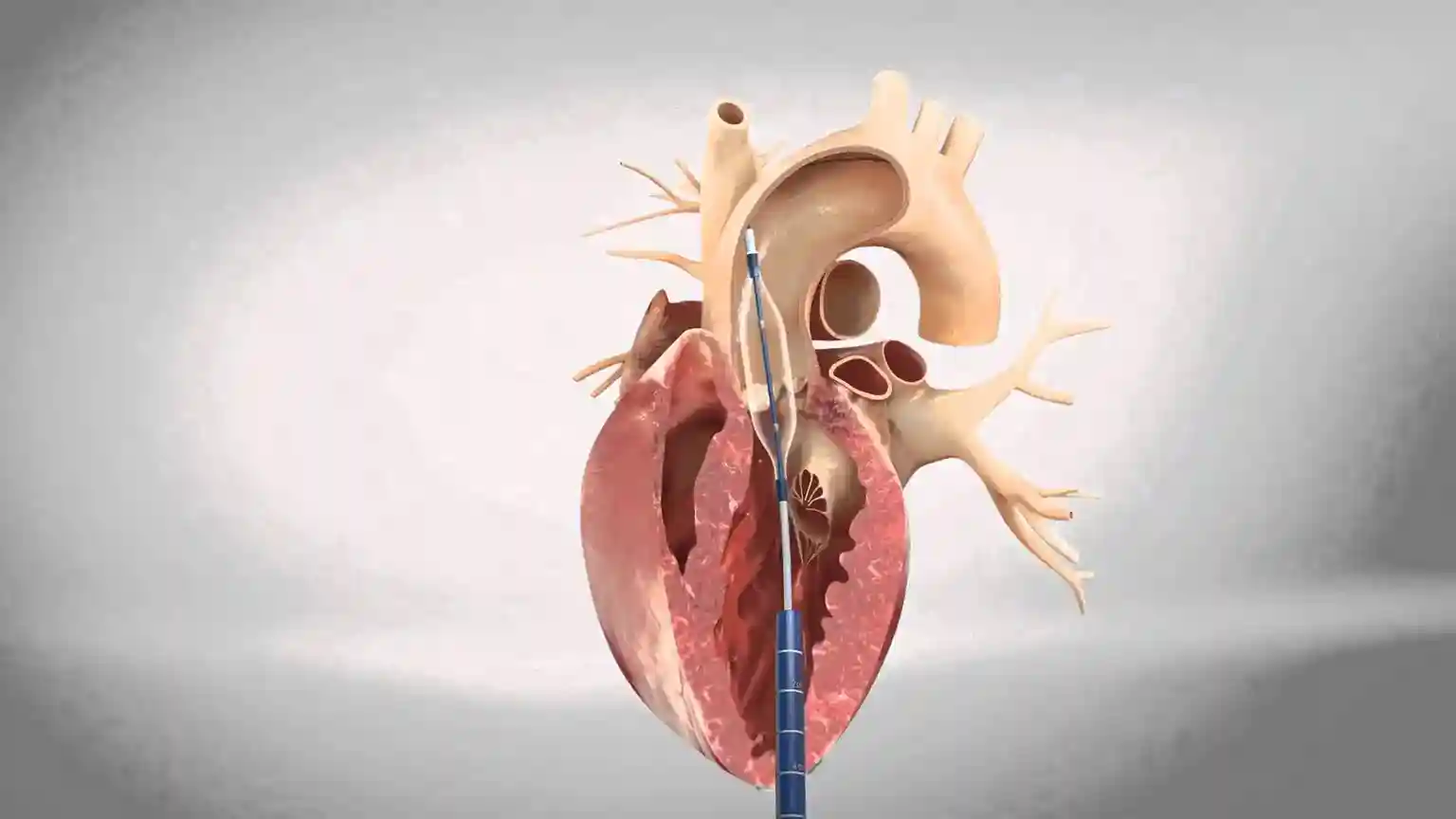 Transcatheter Aortic Valve Replacement (TAVR / TAVI)