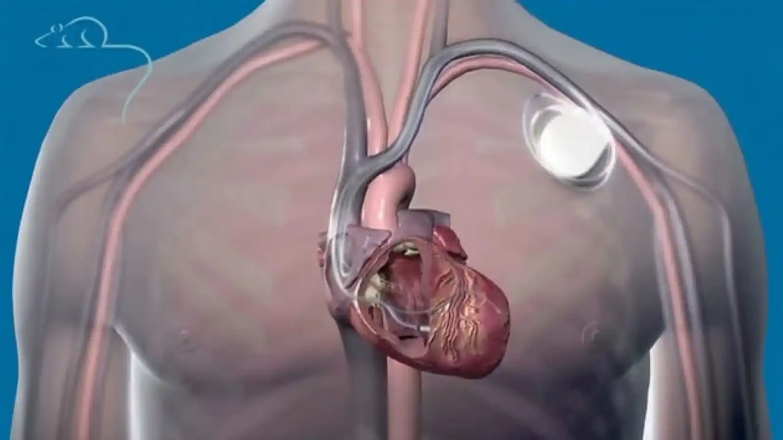 permanent-pacemaker-implantation(PPI)