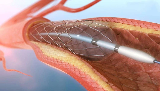 Percutaneous Coronary Angioplasty (PTCA)
