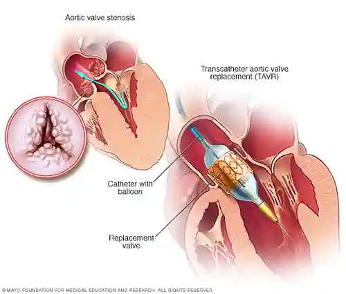 Transcatheter mitral valve replacement(TMVR)